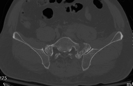 Sacral Fracture Transforaminal